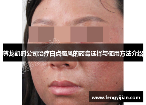 尊龙凯时公司治疗白点癫风的药膏选择与使用方法介绍